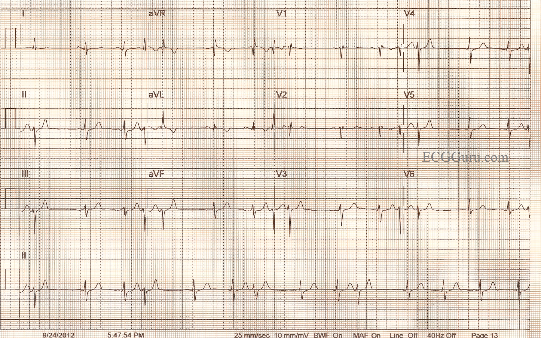 PACs With Left Anterior Fascicular Block Aberrancy ECG Guru